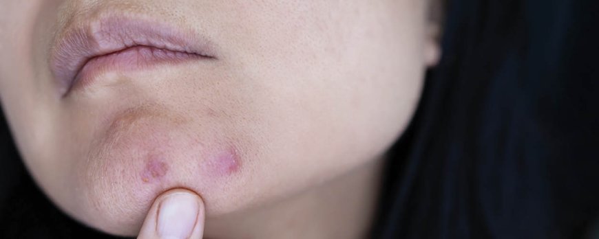 What does acne on chin mean?