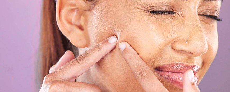 What does acne bacteria feed on?