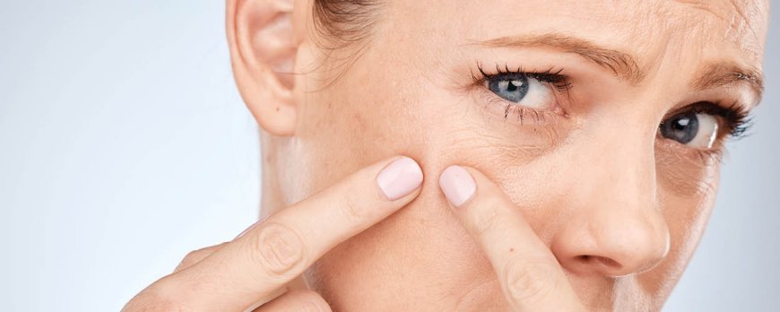 What can make acne worse?