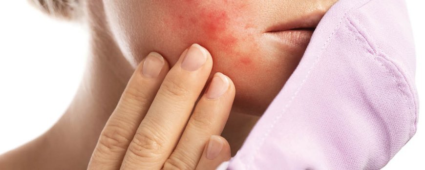 What does cystic acne on cheeks mean?