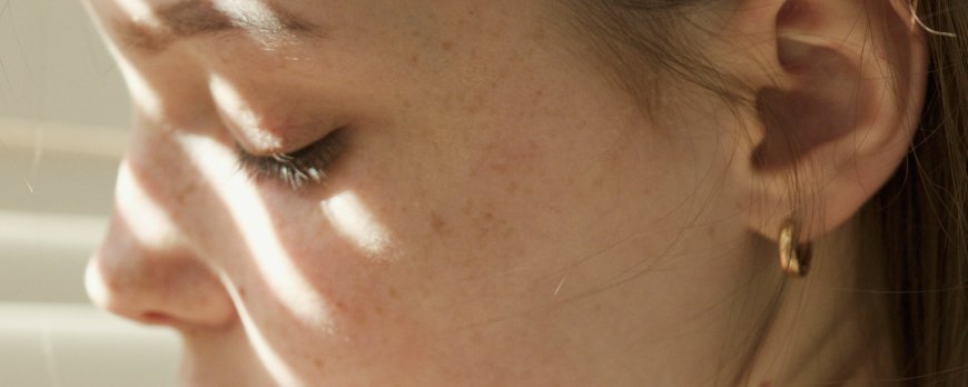 What bacteria causes most acne?