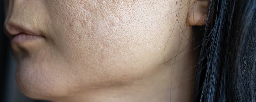 What does acne from stress look like?