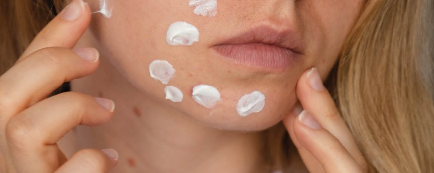 Wat zijn de 7 soorten acne?