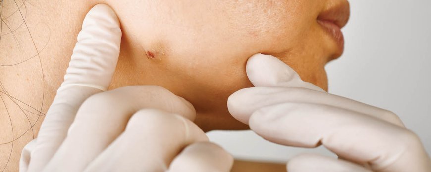 What does a cystic acne look like?